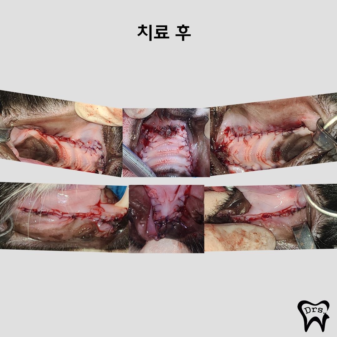 Fotografía intraoral de la encía suturada tras la extracción — registro de cada zona tratada