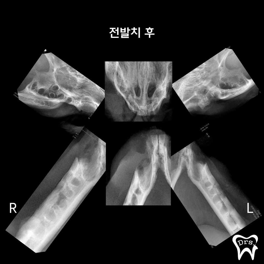 Radiografía dental completa tomada tras la extracción de toda la dentición — se confirma que no quedan raíces