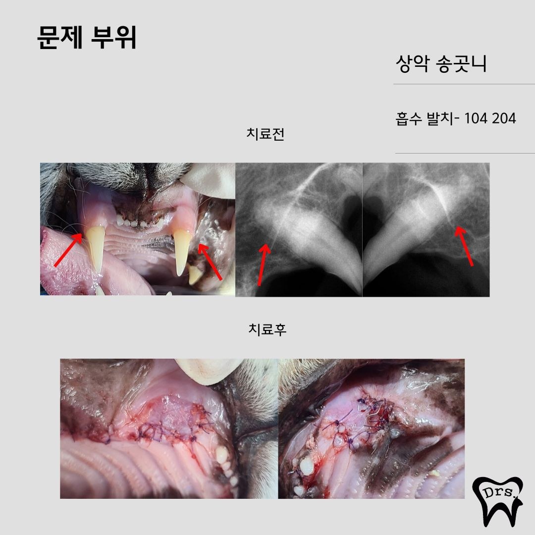 Reabsorción dental de los colmillos maxilares 104 y 204 — informe de extracción (fotografías antes y después con radiografías)
