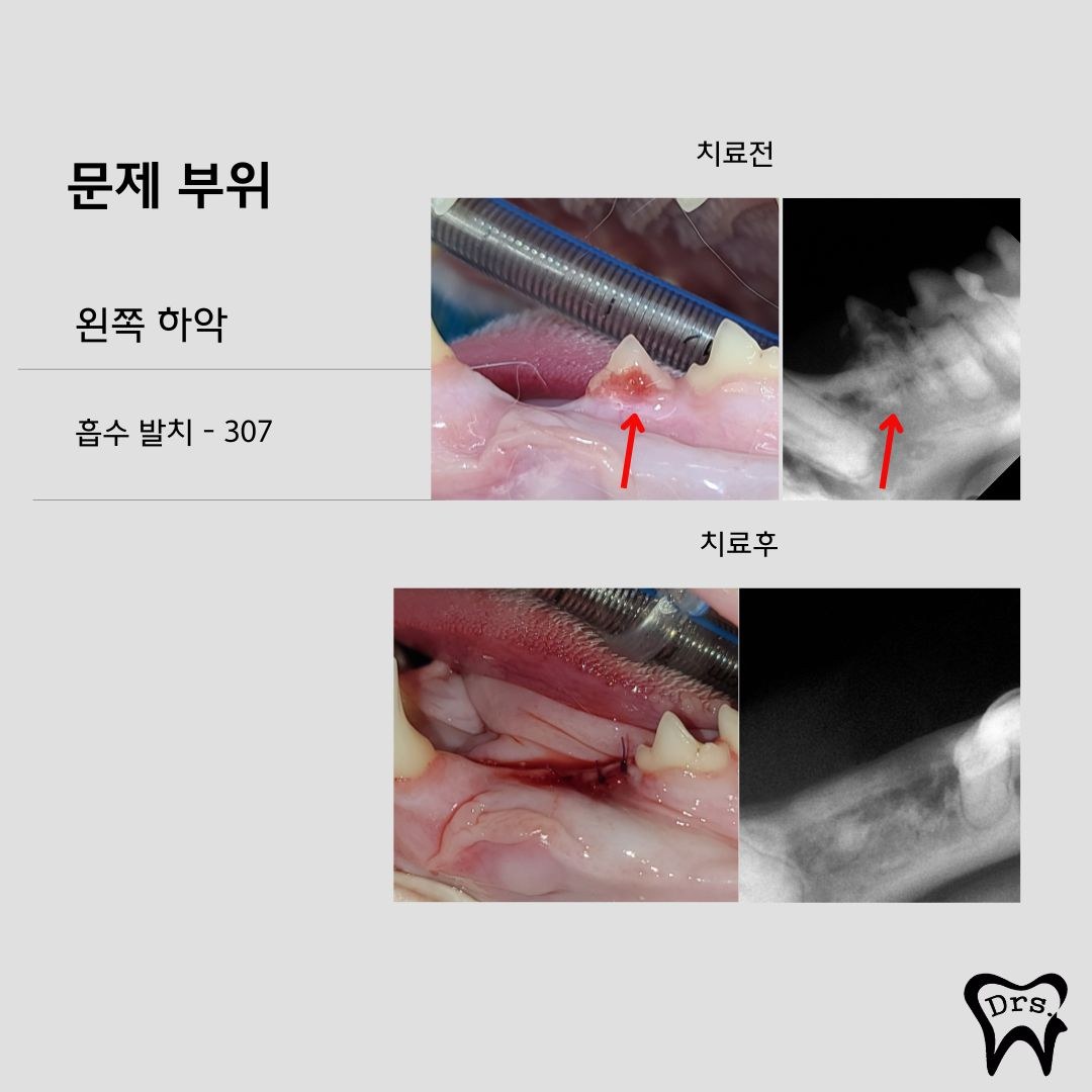Reabsorción dental del diente mandibular izquierdo 307 — informe de extracción (fotografías antes y después con radiografías)