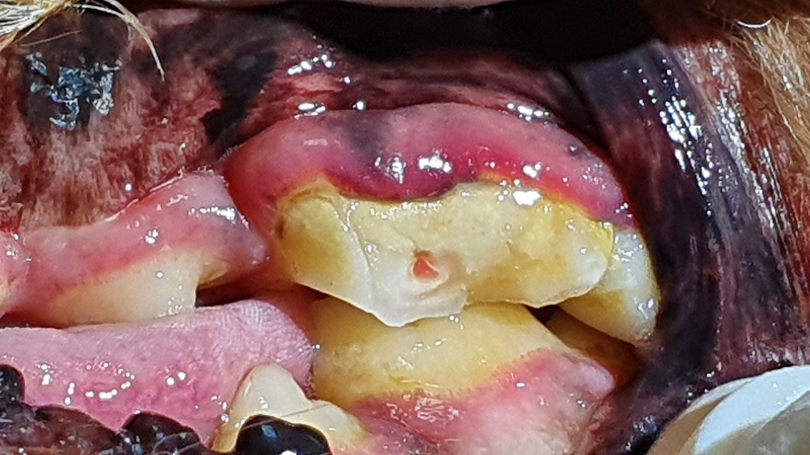 Fotografía intraoral de un diente posterior grande fracturado, con la pulpa expuesta y enrojecida en el centro