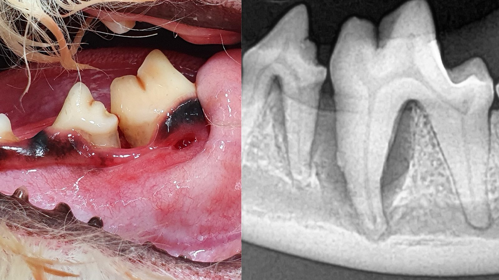 Fotografía intraoral de una periodontitis avanzada y radiografía dental de la misma zona. El hueso que sostiene los dientes se ha perdido