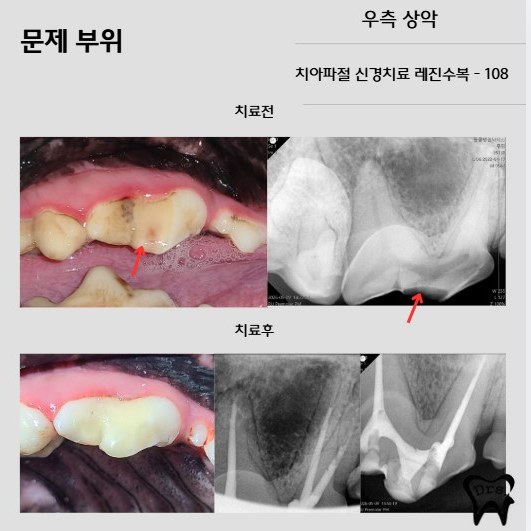 Fractura del diente maxilar derecho 108 — informe de endodoncia y restauración de composite (fotografías antes y después con radiografías)