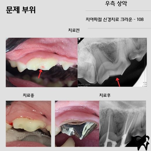 Fractura del diente maxilar derecho 108 — informe de endodoncia y corona (fotografías antes, durante y después con radiografías)